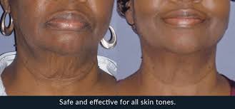 Thank you for your question. Morpheus8 Radio Frequency Skin Tightening Treatment Aesthetic Treatments In Uk