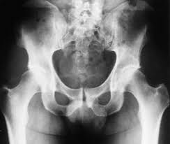 Image result for Pubic Apophysitis