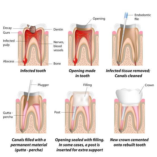 Does a Tooth Need a Root Canal Treatment?
