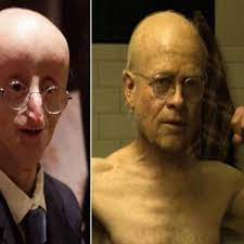 Real Life Benjamin Button Dies Of Old Age At 17 After Battle With Rare Condition Daily Star