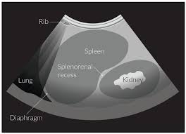 You may also feel pain in the left side of your chest, under your left ribs, or in your left shoulder. Splenic Rupture Amboss
