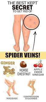 The Best Kept Secret To Get Rid Of Spider Veins Get Rid Of Spider Veins Spider Veins Varicose Vein Remedy