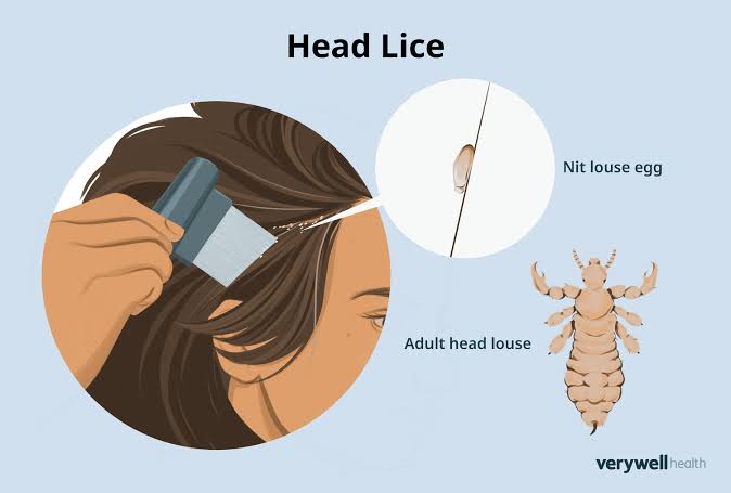 How to Spot Lice and Nits in Your Child's Hair