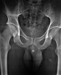 Pelvic X-ray showing the radio-opaque shadow in the penile shaft. |  Download Scientific Diagram