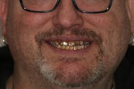 Dental Implants Herndon VA