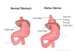 Image result for stomach hernia symptoms