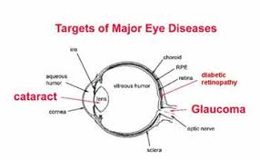 Cataracts Optometrist In Coldwater Sturgis Mi And