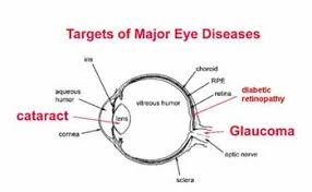 cataracts optometrist in coldwater sturgis mi and