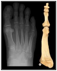 Radiographs were reviewed for location of we found simple ruler measurement from the proximal tip of the fifth metatarsal to the fracture to. Non Randomised Retrospective Study Of Jones Fractures Treated By Conservative Treatment