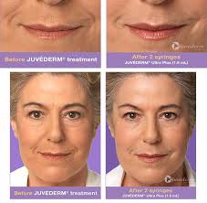 What are the different types of juvederm? Juvederm Richmond Short Pump Va