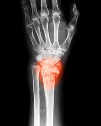 Image result for Scaphoid Bone