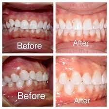 Braces Worked Wonderfully As We Corrected This Patient S Deepbite At Amanda Gallagher Orthodontics Agortho Orthodontics Amanda