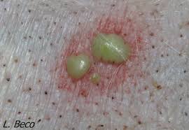 Die analysenzeit beträgt derzeit aufgrund des hohen probenaufkommens in der regel mindestens 24 bis 48 stunden. Multi Resistenten Widerstandigen Mrsa Mrsp Mrsi Staphylokokken Bakterien
