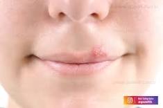 lip Pimple causes the Shocking Revelation of Pimple on lip Remove