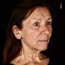 When the skin is severely damaged from...