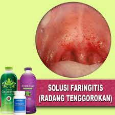 Obat sakit tenggorokan di apotek tidak banyak membantu? Jual Paket Obat Herbal Radang Tenggorokan Faringitis Gejala Bersin Pilek Jakarta Timur Pratiwi Olshop Tokopedia