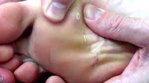 Order online or call for a quote! Best Way To Get Rid Of Verruca Plantar Wart Now How To Use This For Fast Results Youtube