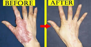 Burns In Many Cases Can Be Very Painful There Are Three Degrees Of Burns First Degree Second Degree And Third Degr Burn Scar Remedies Burn Remedy Skin Burns