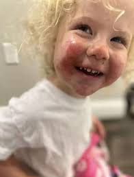 Mum's warning after toddler suffers extreme burns from brushing up against  plant