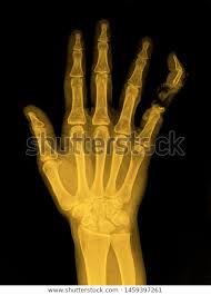 Maybe you would like to learn more about one of these? Manus X Ray Anatomy Radiology Radiographic Stock Photo Edit Now 1459397261 X Ray Photo Editing Radiology