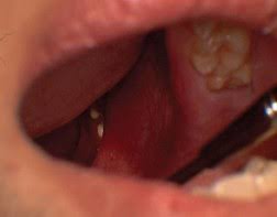 Image result for Tonsillolith