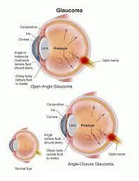 Pin On Glaucoma