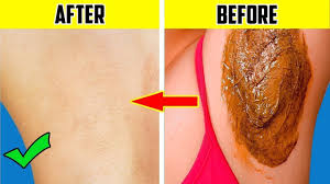 It is common after shaving your underarms and should go away hair removal techniques such a waxing need to be gentle too. How I Removed My Underarm Hair Permanently At Home 100 Working Remove Armpit Hair Naturally Youtube
