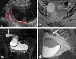 Maybe you would like to learn more about one of these? Leaking Hemorrhagic Ovarian Cyst A 23year Old Female Patient Presented Download Scientific Diagram