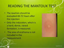Due to the type of test, a ppd test result returns more false positives than a quantiferon test. The Mantoux Test