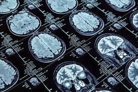 Det er også mere sandsynligt hos voksne med neurologiske problemer som parkinsons sygdom, svækket immunsystem eller personer, der genvinder et hjerteanfald eller slagtilfælde (disse patienter er mere tilbøjelige til at udvikle seborrhoe dermatitis og skæl). Nyhet Helse Dette Er Den Sykdommen Nordmenn Frykter Mest Slik Halverer Du Risikoen For A Bli Rammet