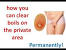 Boils On Vag Lips Pictures