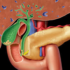 When gallstones are present in the gallbladder itself, it is called cholelithiasis. Index Of Dept Radiology Radiologysite Images Med Students 12 Biliary