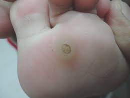 Getting Rid Of Plantar S Warts Dr Jason Kaster D C Fort Myers