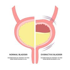 Image result for Pelvic Floor Dysfunction