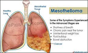 We did not find results for: Mesothelioma Prognosis Mesothelioma Bowel Obstruction Symptoms