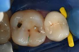 Want to be notified of new releases in samuliheikkinen/caries_detector? Small Cavities Big Problems Diagnosis And Treatment Of Non Cavitated Carious Lesions Dentalcompare Com