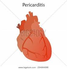 Myocarditis is an inflammation of the heart muscle (myocardium). Pericarditis Vector Photo Free Trial Bigstock
