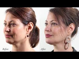 Hairstyles for women with big.jowls. Non Surgical And Surgical Jowl Reduction Melbourne