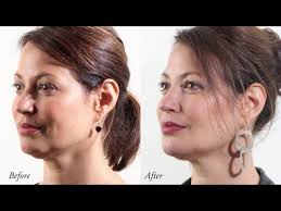 Maybe you would like to learn more about one of these? Non Surgical And Surgical Jowl Reduction Melbourne