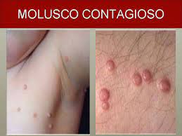 Gypseum associada à escabiose crostosa claudia schermann poziomczyk 1 bruna köche 2 fabio luis becker 3 sérgio ivan torres dornelles 4 renan rangel bonamigo 5 abstract:tinea pseudoimbricata is related to t. Doenas De Pele Na Infncia Internato Escs Amanda