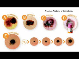 You would think this would be close enough to home to make me vigilant with getting my own skin checked yearly, but it hasn't. Know Warning Signs Of Melanoma Youtube