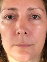 Face Yoga Method Results
