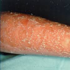 These areas are red, or purple on some people with darker skin, dry, itchy, and scaly. Tipos De Psoriase Psoportugal