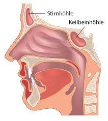 Es gibt eine akute und chronische form. Chronische Sinusitis Ursachen Symptome Therapie