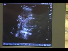 Su superficie cerebral, que hasta este momento era lisa, empieza a tener surcos. Semana 20 De Gestacion 19 Semanas De Embarazo Ecografia Video