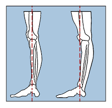 Twisting the knee is the common way of tearing the meniscus especially when the foot is planted when it twists. Knee Hyperextension Its All In Your Mind Ellie Herman Pilates