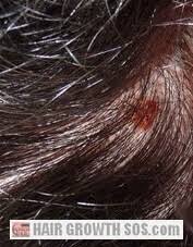 It is one of the symptoms of alopecia areata. Rogaine Side Effects Tingling Sensation Low Libido Forehead Rash
