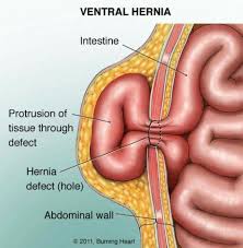 Ventral Hernia Abdominal Hernia Umbilical Hernia Icu Nursing