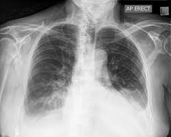 You ascertain that this film is that of your patient's. Pleural Effusion Chest X Ray Medschool