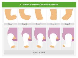 At initial diagnosis, 69 feet (40 fetuses) were classified as isolated club foot and 22 feet (12 fetuses) as complex club foot. Foot Deformities Concise Medical Knowledge